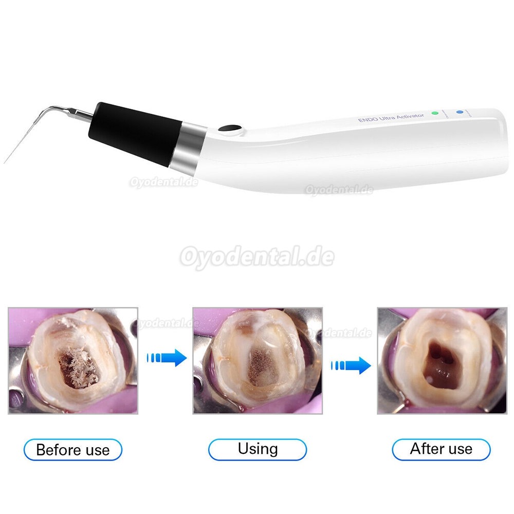 Sonic Ultraschall endoactivator handstück für Irrigator endodontie Schnurlos+6pcs Titanspitzen